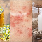 Recetas Naturales para el Tratamiento de las Alergias Cutáneas