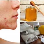 recetas-naturales-para-el-tratamiento-del-acne